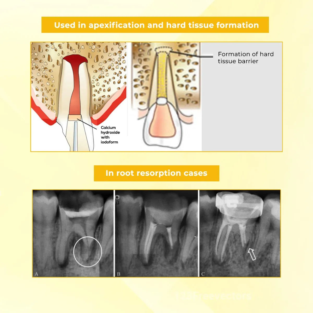 Waldent RCTpex Root Canal Filling Material (Radiopaque)