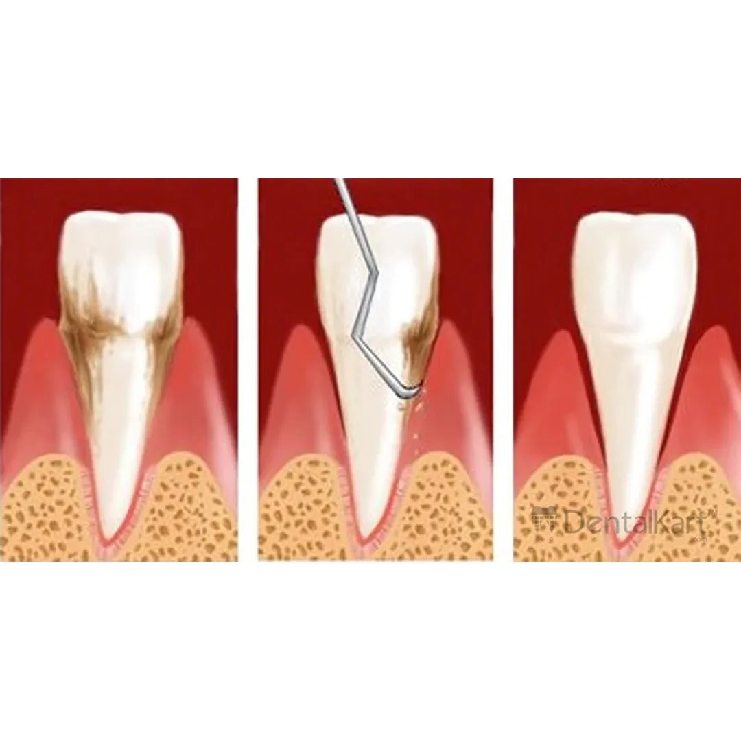 GDC Columbia Curettes 2r/2l Anterior Application #6 (Sc2r/2l)