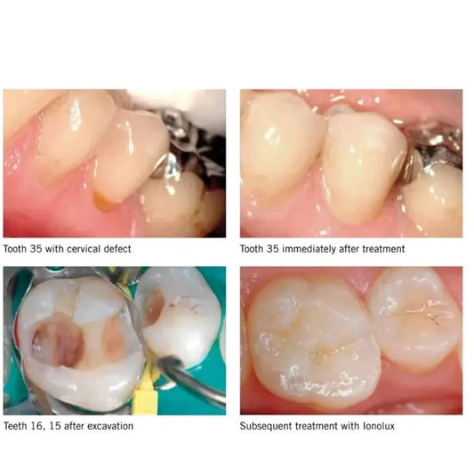 SafeEndo GlassyRestore Restorative Cement