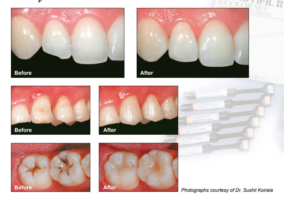 Shofu Beautifil II Dental Composite Basic Kit