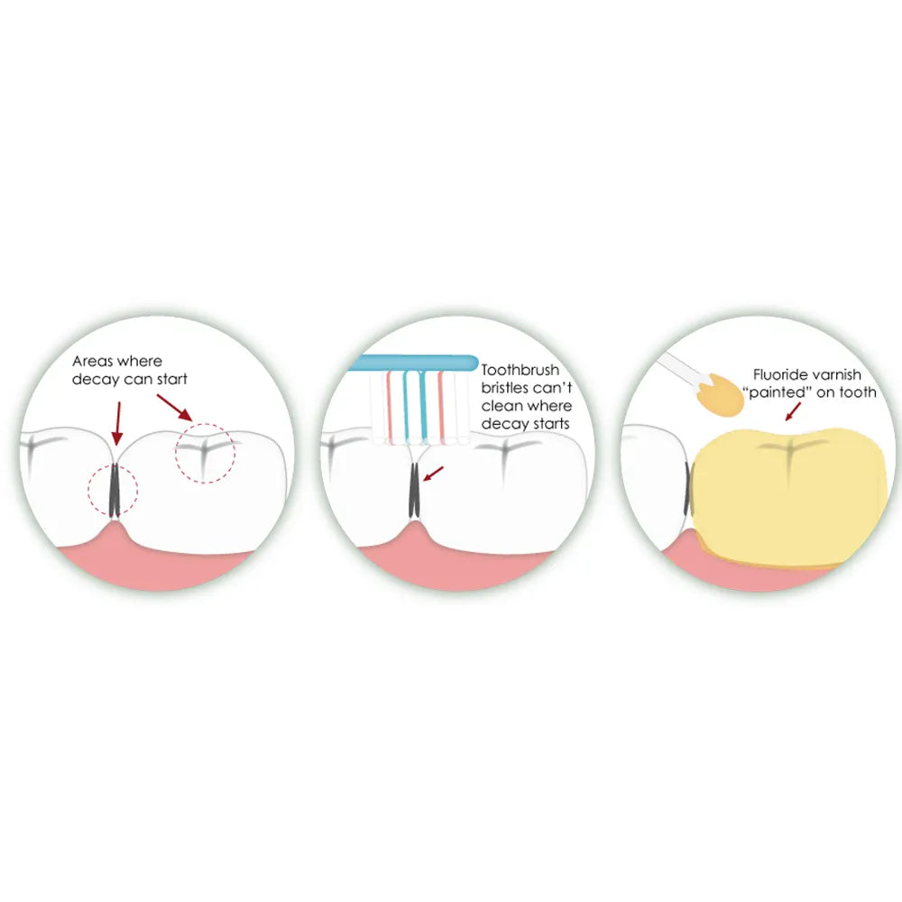 Voco Profluorid Varnish - Single Dose Refills